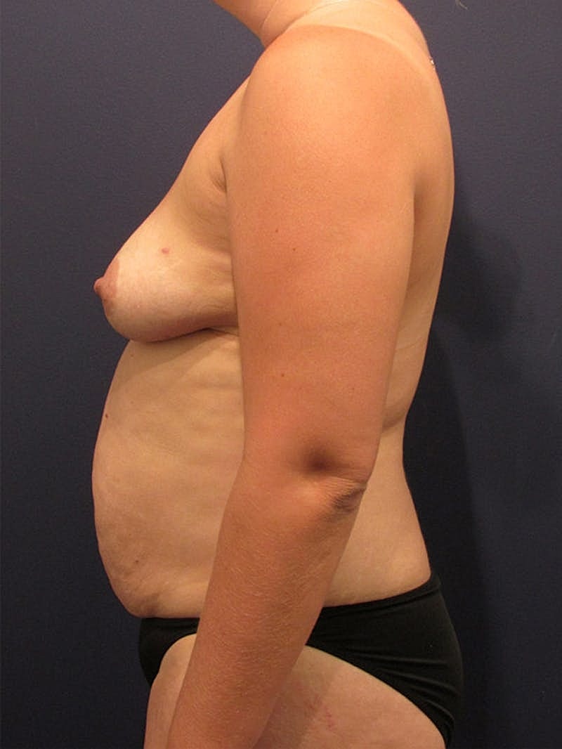 Breast Reconstruction Before & After