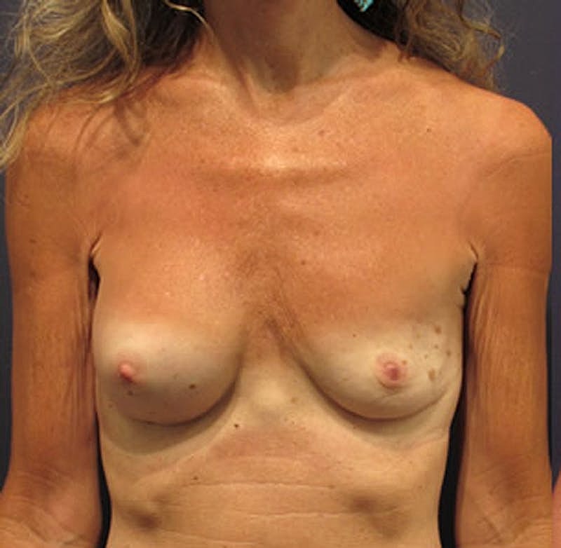 Breast Reconstruction Before & After