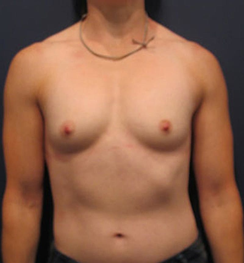Breast Reconstruction Before & After