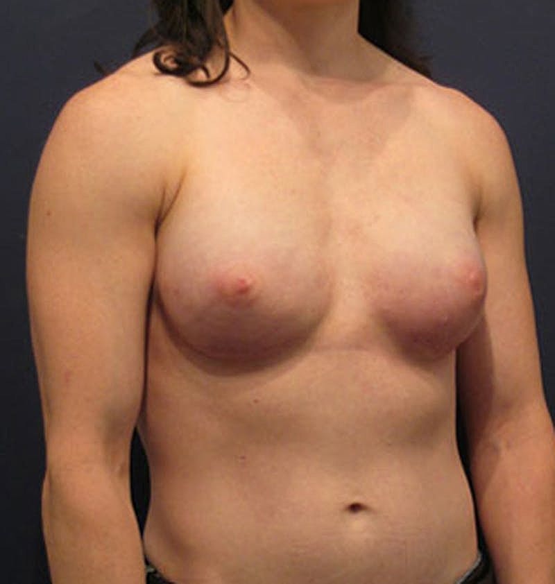 Breast Reconstruction Before & After