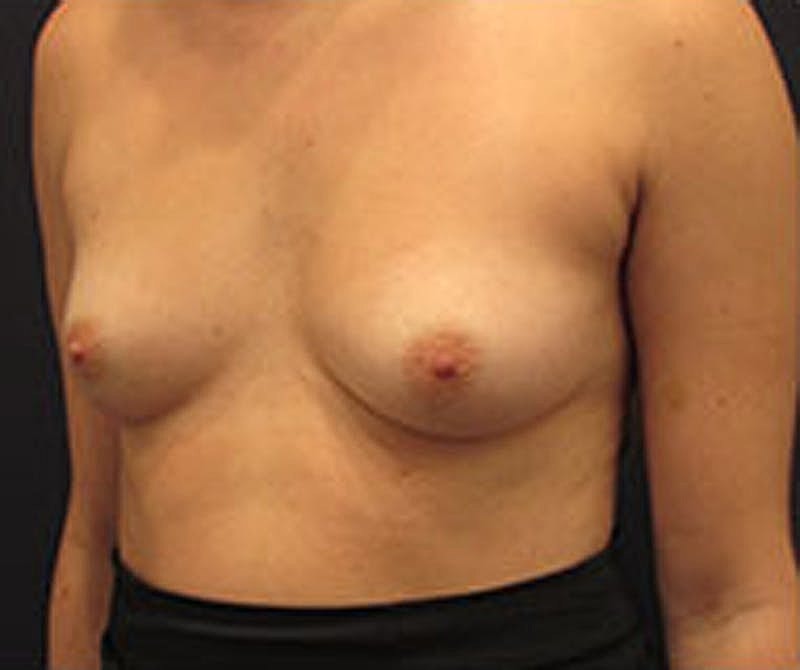 Breast Reconstruction Before & After