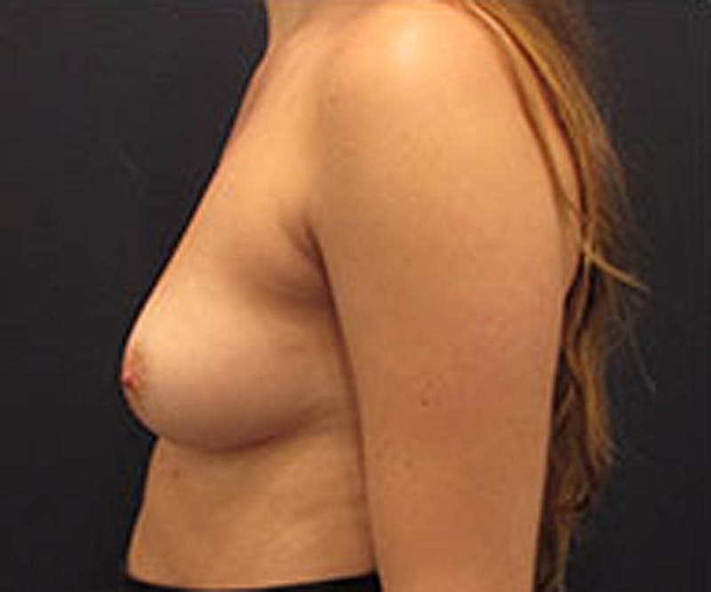 Breast Reconstruction Before & After