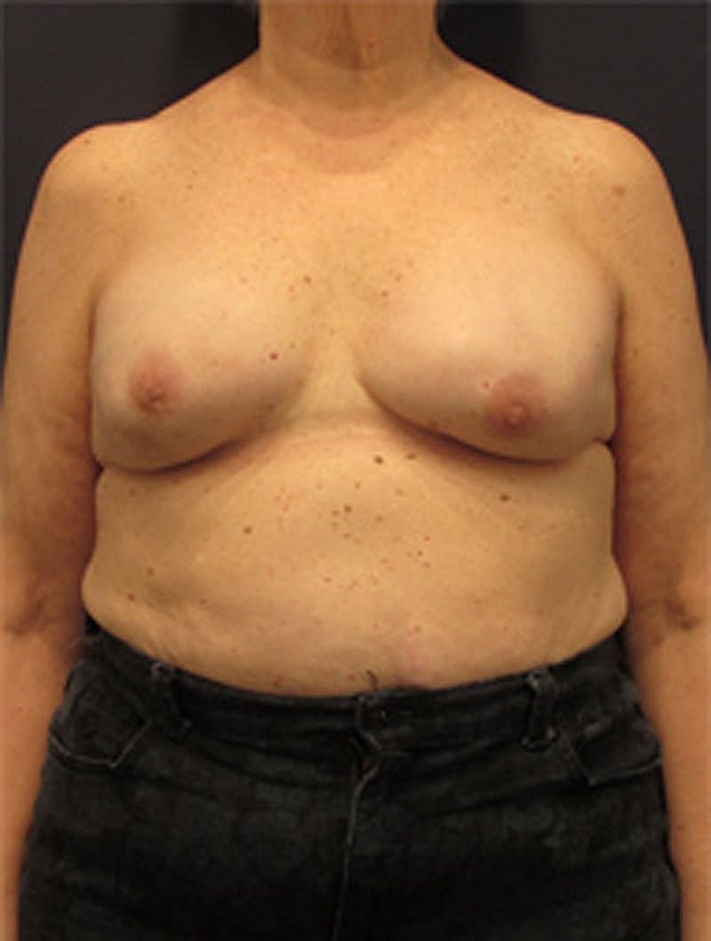 Breast Reconstruction Before & After