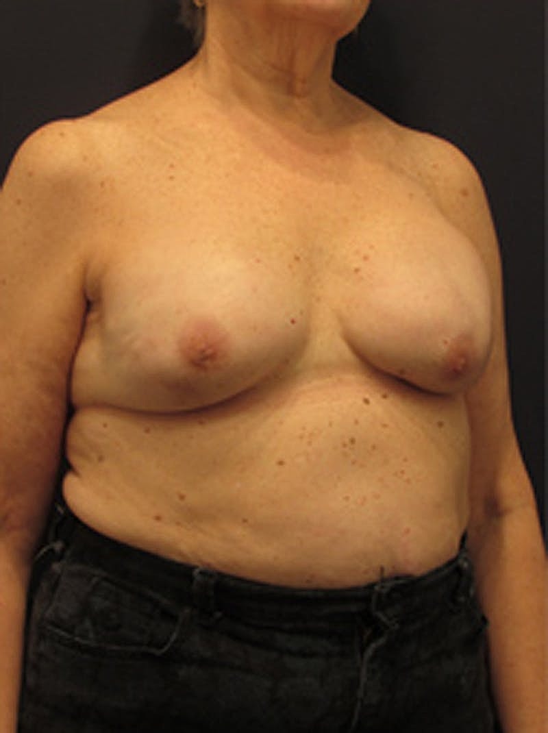 Breast Reconstruction Before & After