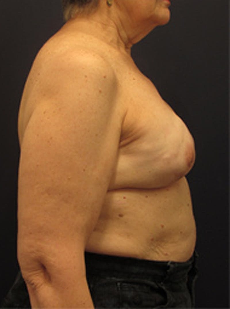 Breast Reconstruction Before & After