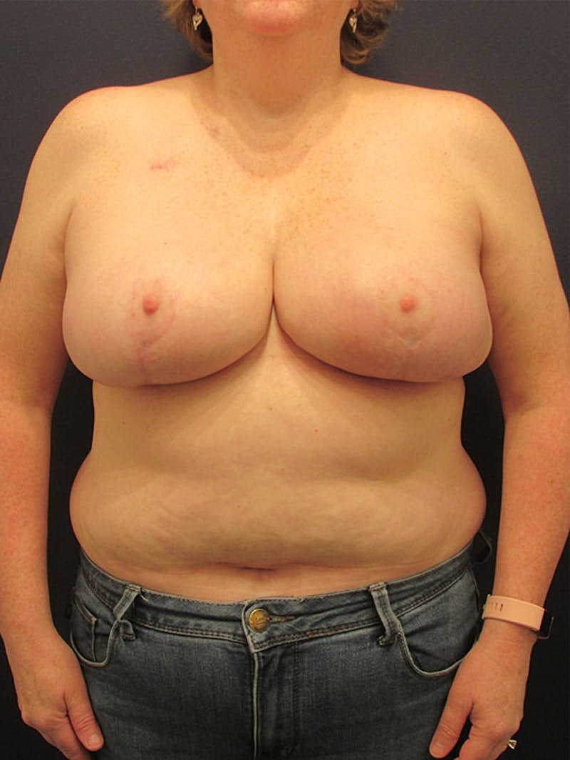 Breast Reconstruction Before & After