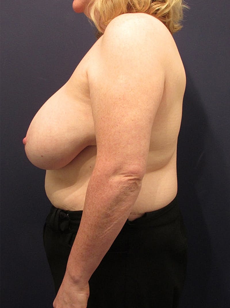 Breast Reconstruction Before & After