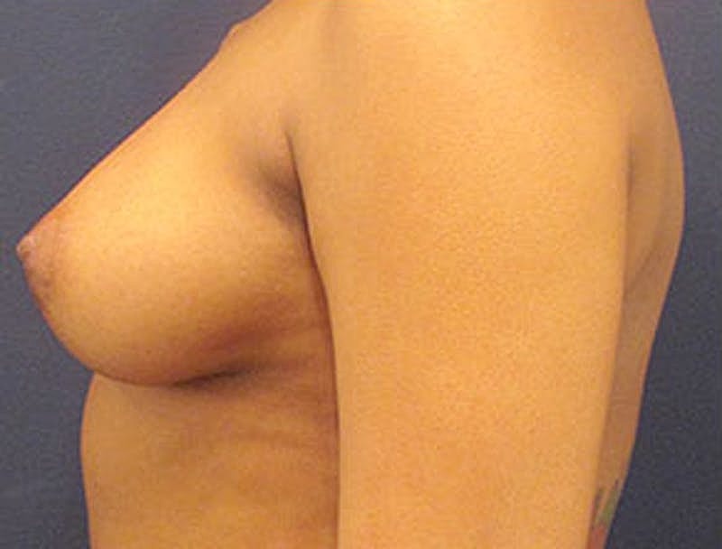Breast Reconstruction Before & After
