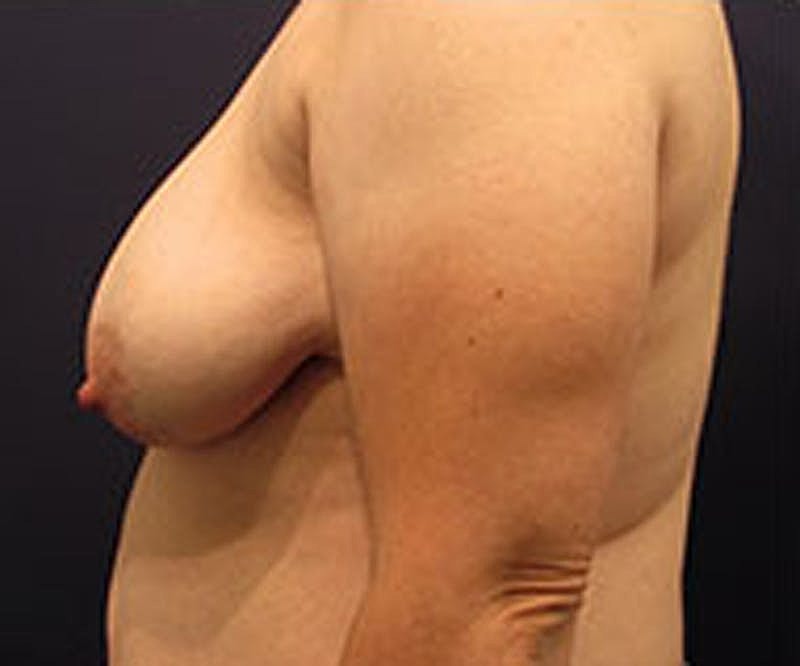 Breast Reconstruction Before & After