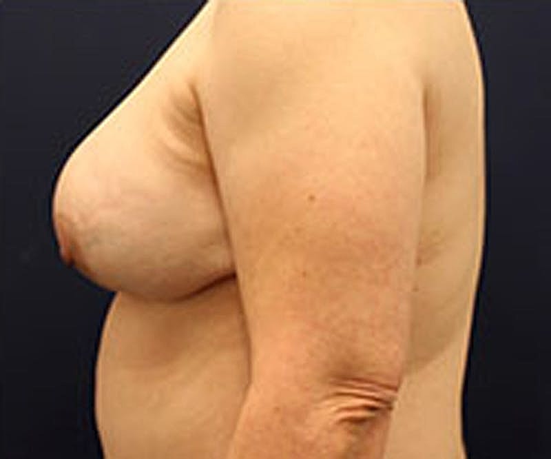 Breast Reconstruction Before & After