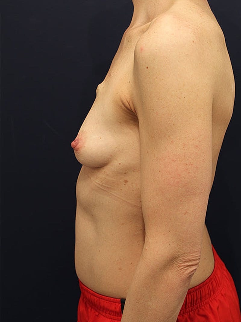 Breast Reconstruction Before & After