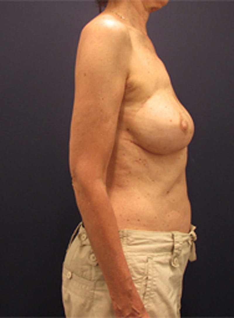 Breast Reconstruction Before & After