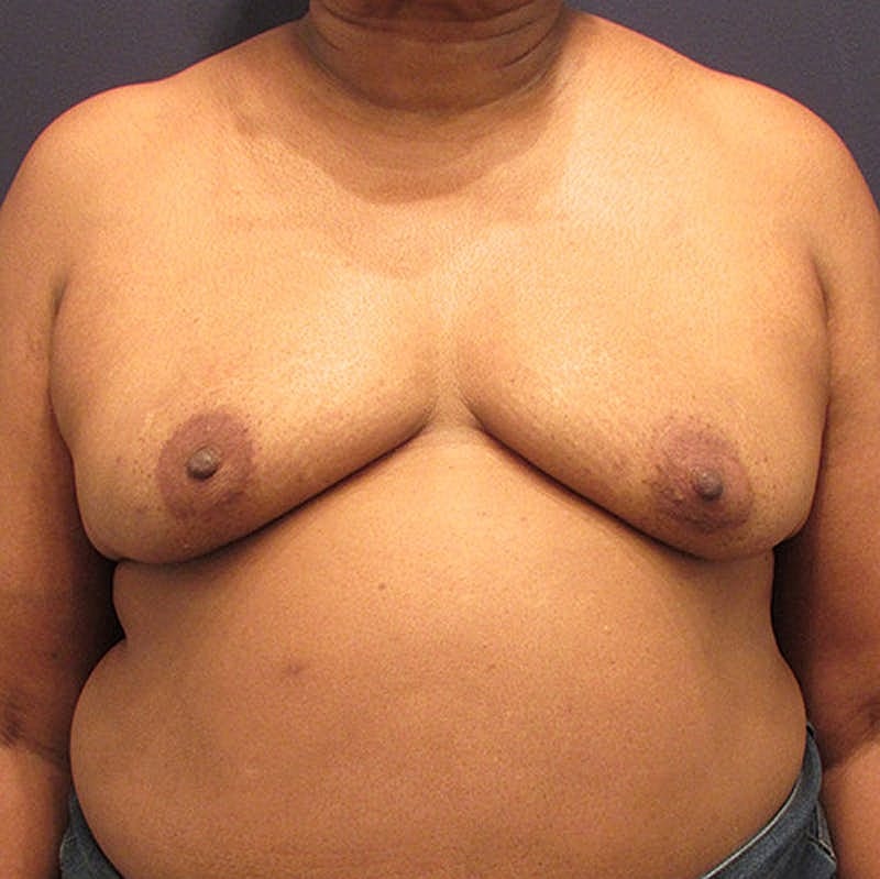 Breast Reconstruction Before & After