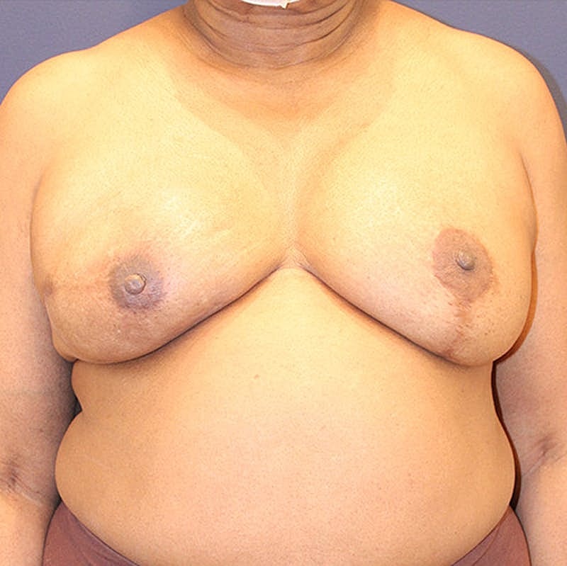 Breast Reconstruction Before & After