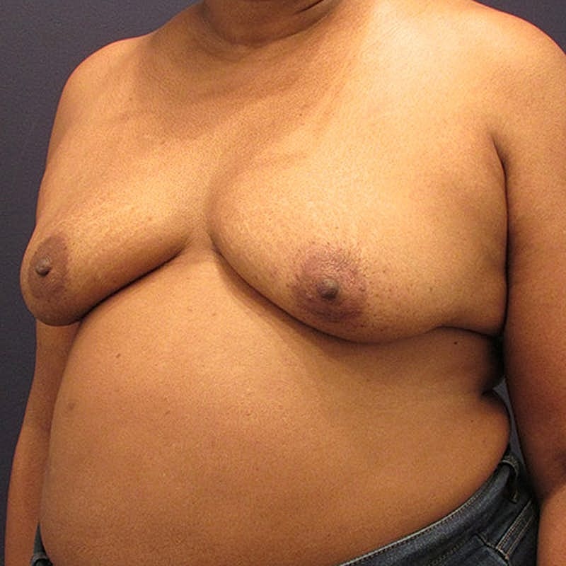 Breast Reconstruction Before & After