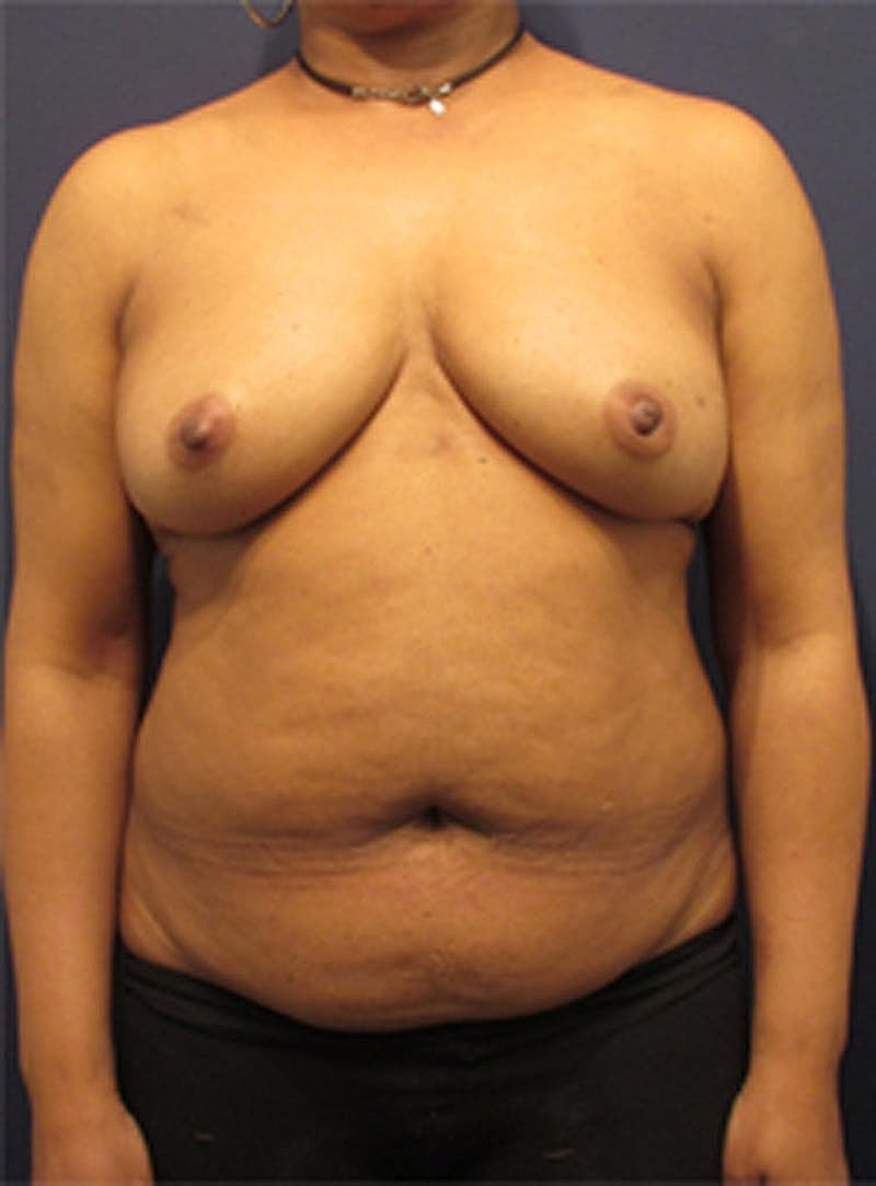 Breast Reconstruction Before & After