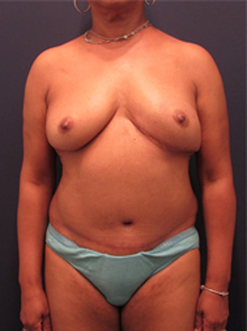 Breast Reconstruction Before & After