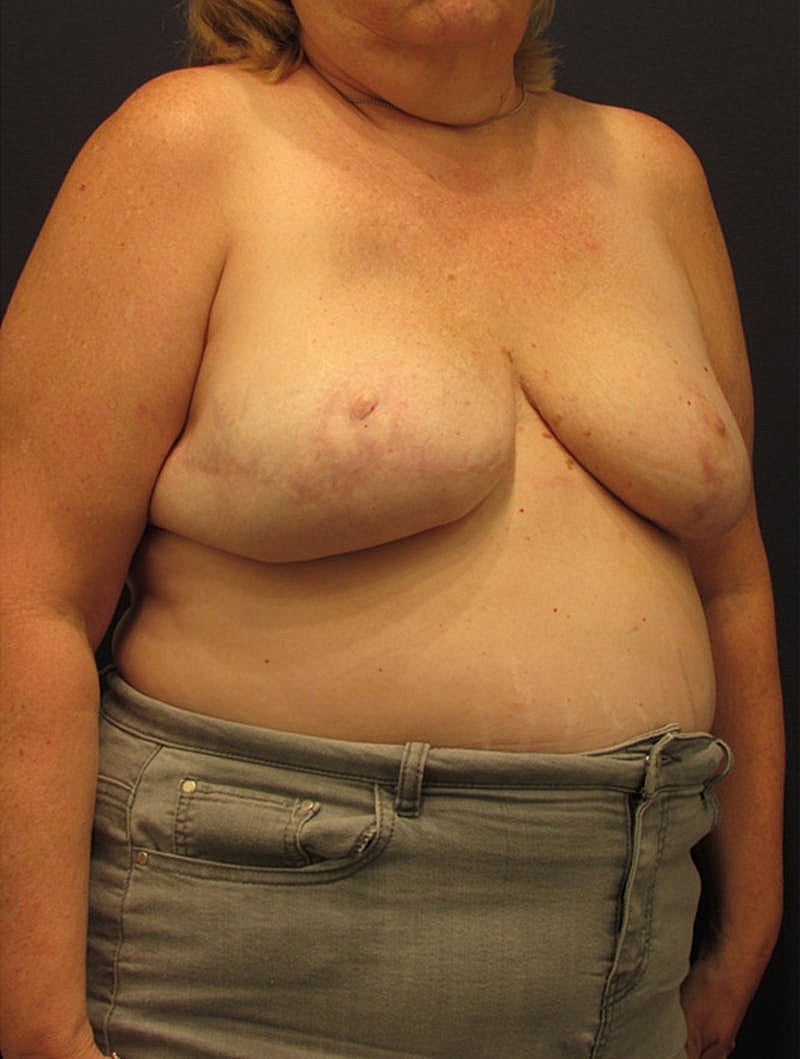Breast Reconstruction Before & After