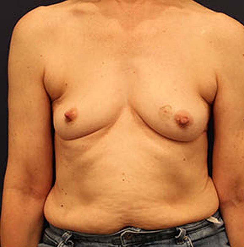 Breast Reconstruction Before & After