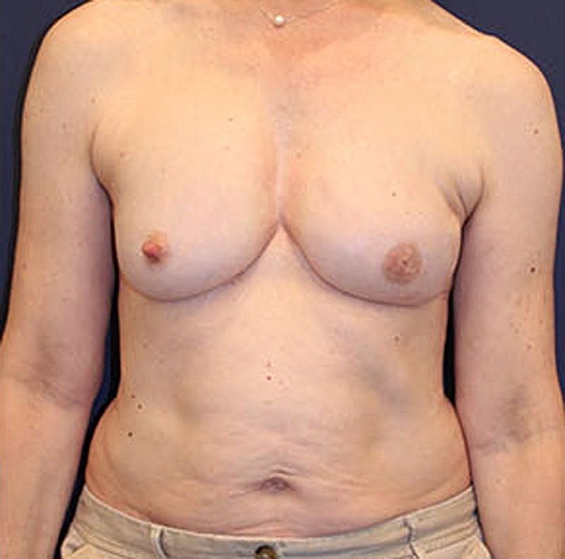 Breast Reconstruction Before & After