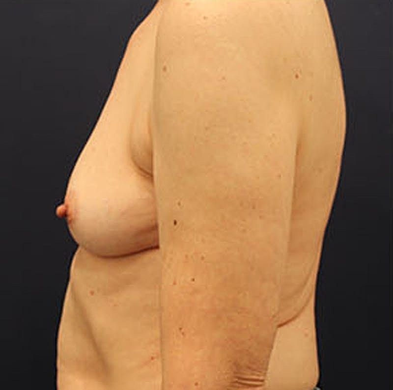 Breast Reconstruction Before & After