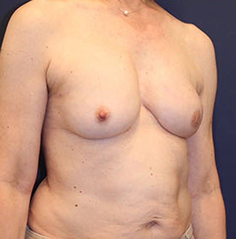 Breast Reconstruction Before & After