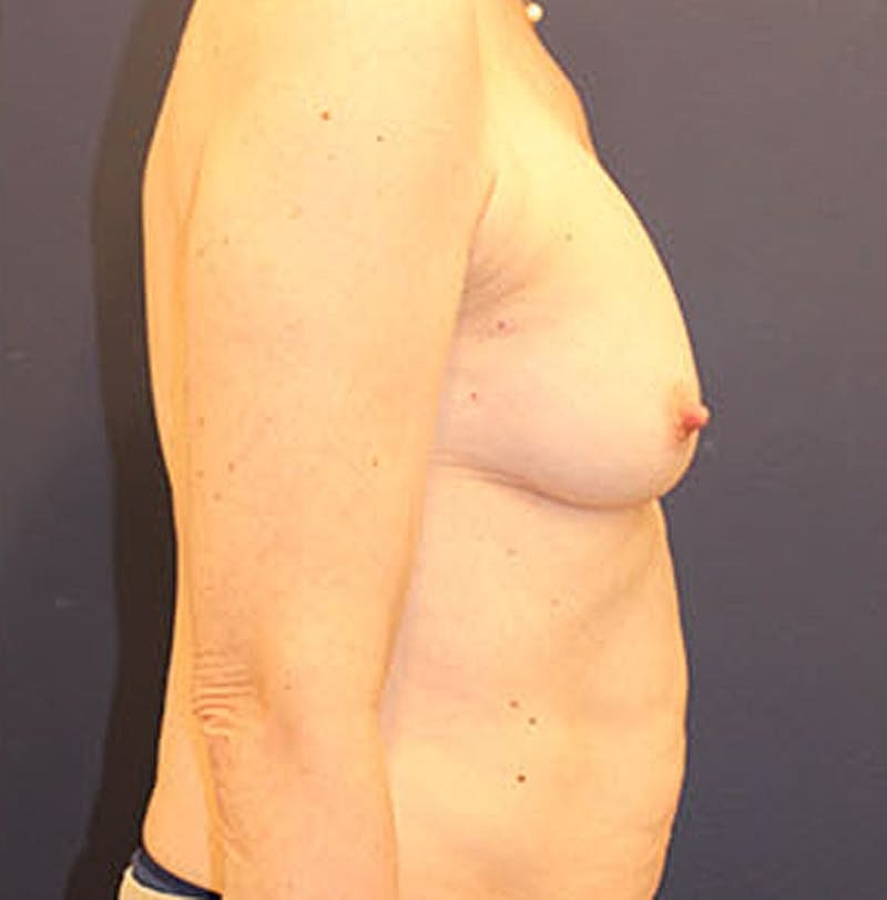 Breast Reconstruction Before & After