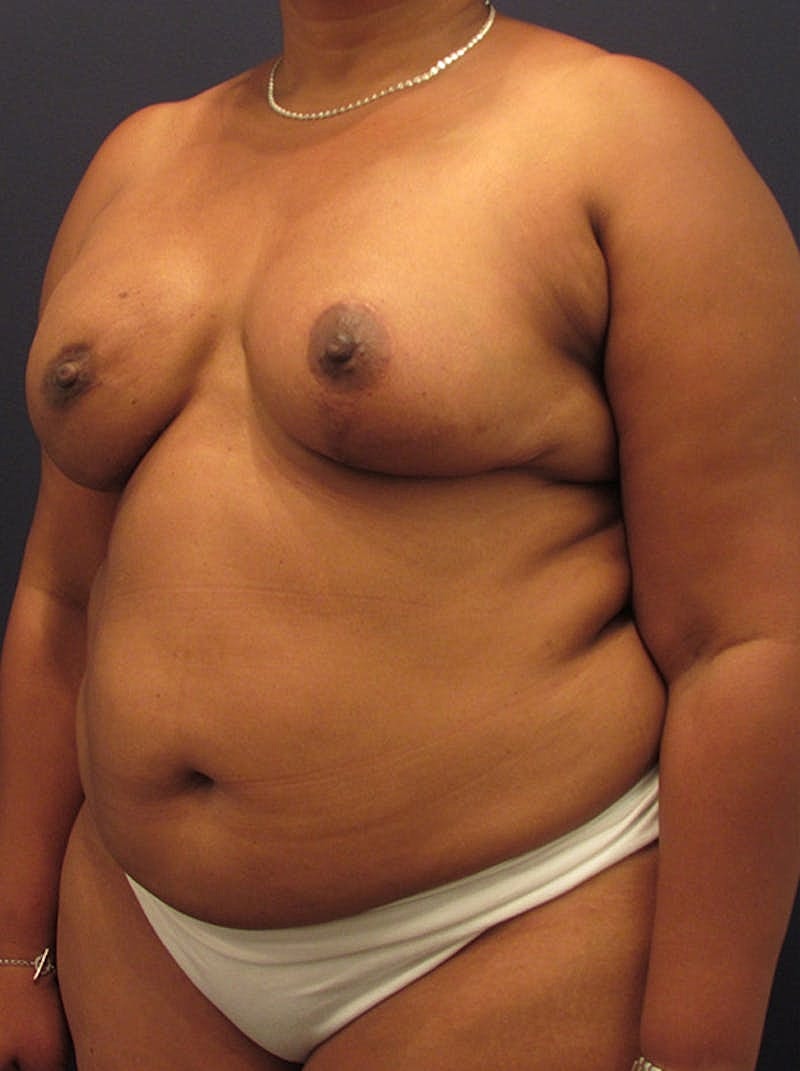 Breast Reconstruction Before & After