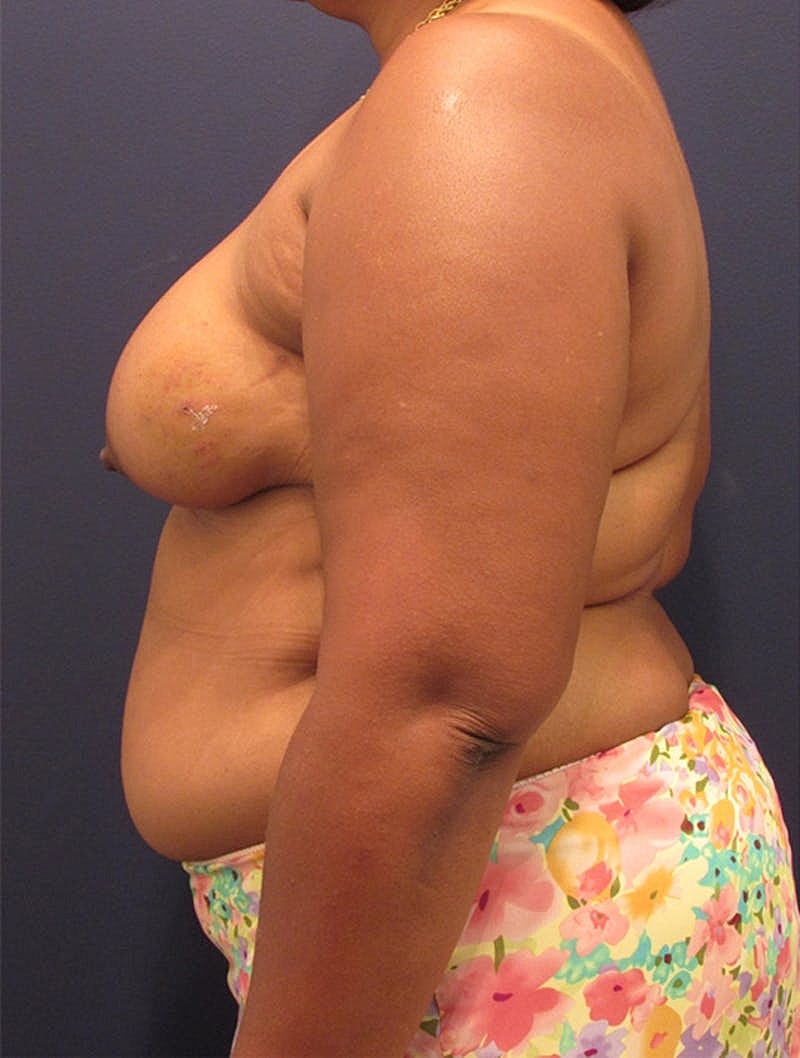 Breast Reconstruction Before & After