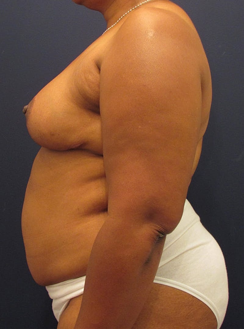 Breast Reconstruction Before & After