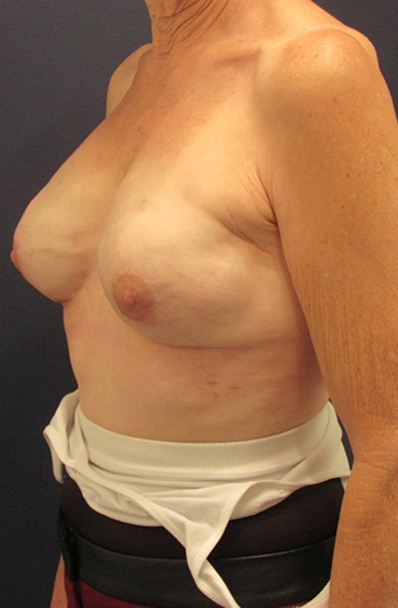 Breast Reconstruction Before & After
