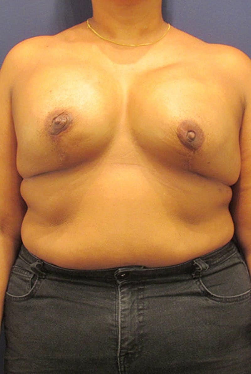 Breast Reconstruction Before & After