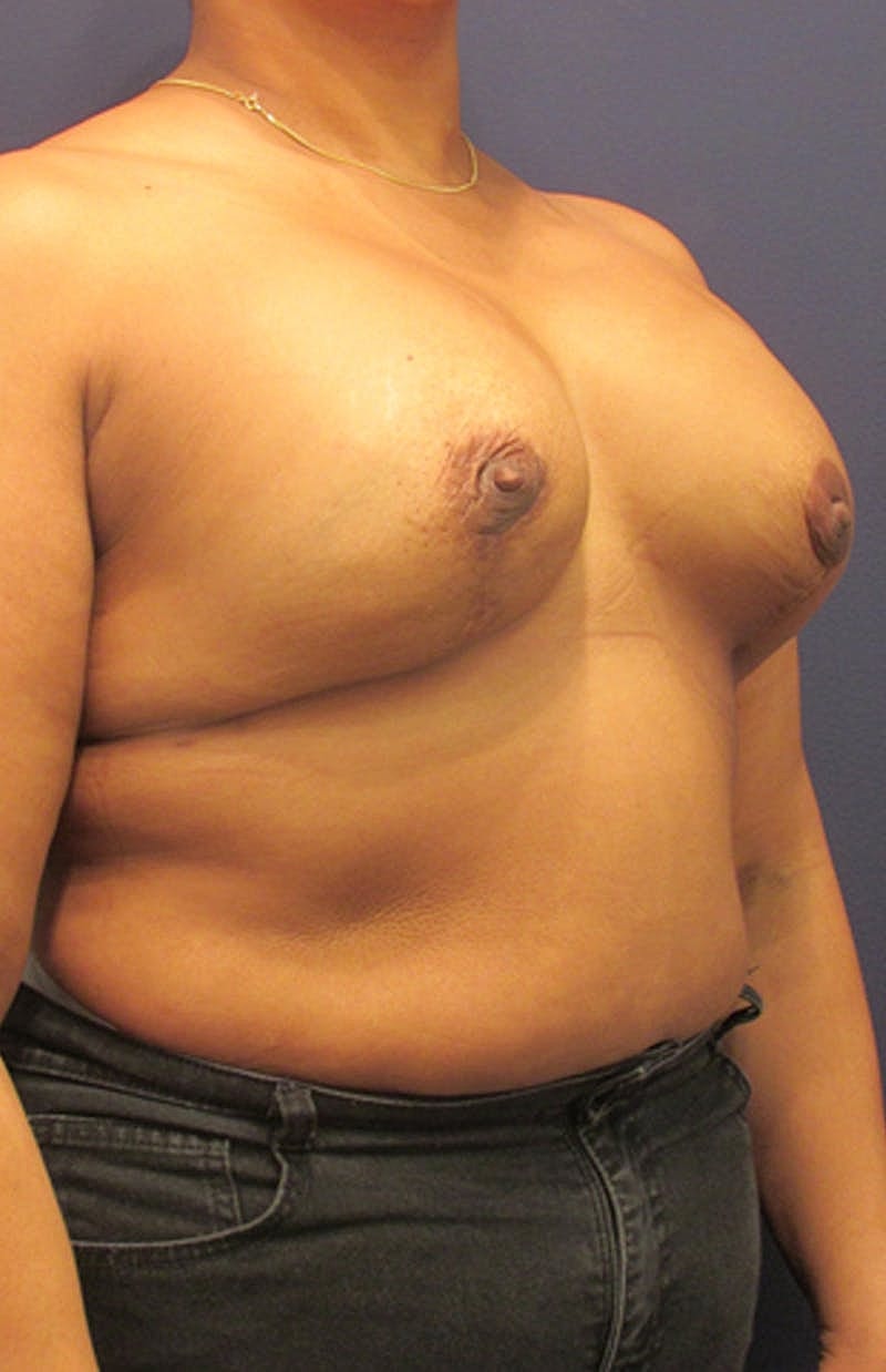 Breast Reconstruction Before & After
