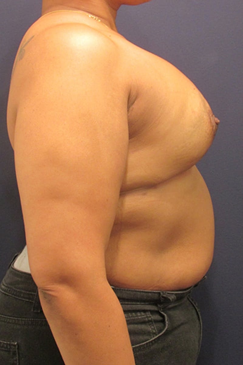 Breast Reconstruction Before & After