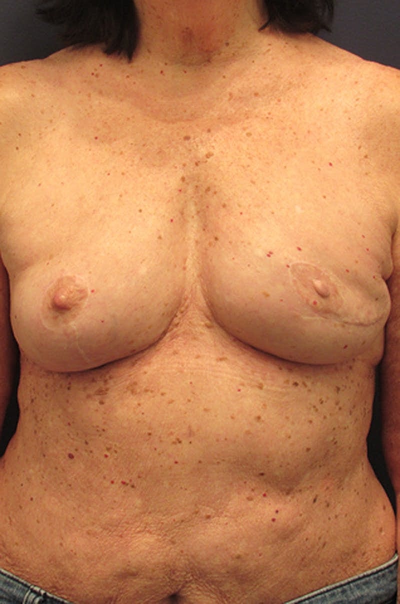 Breast Reconstruction Before & After