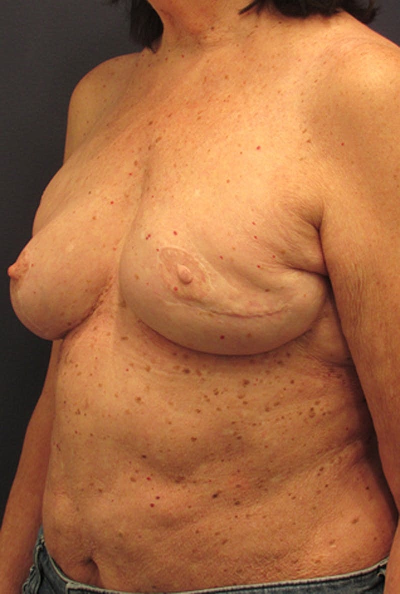 Breast Reconstruction Before & After