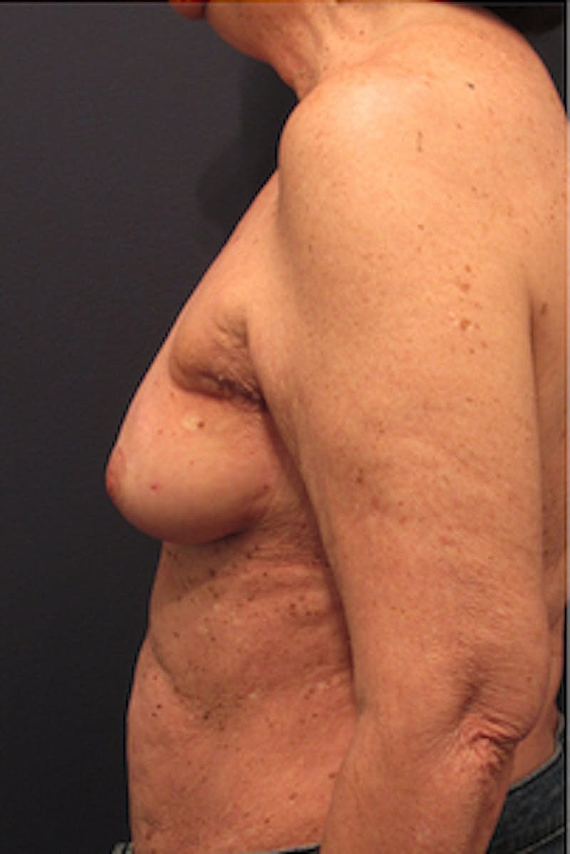 Breast Reconstruction Before & After