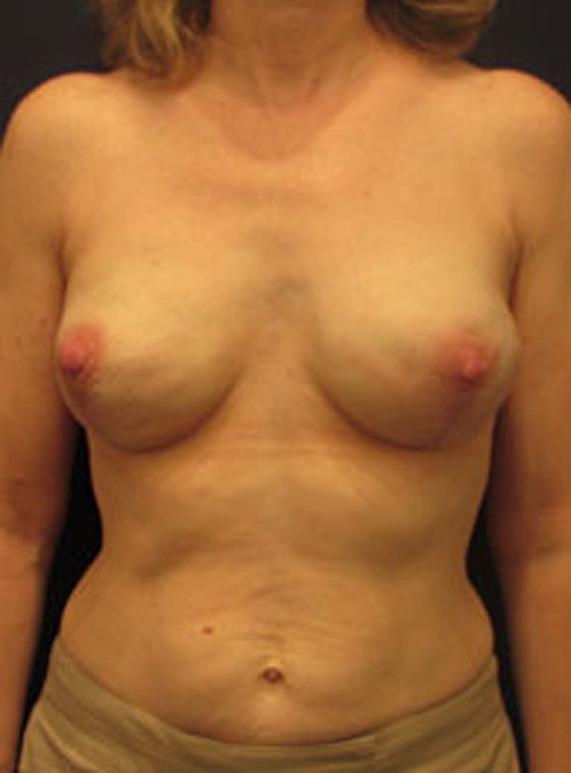 Breast Reconstruction Before & After
