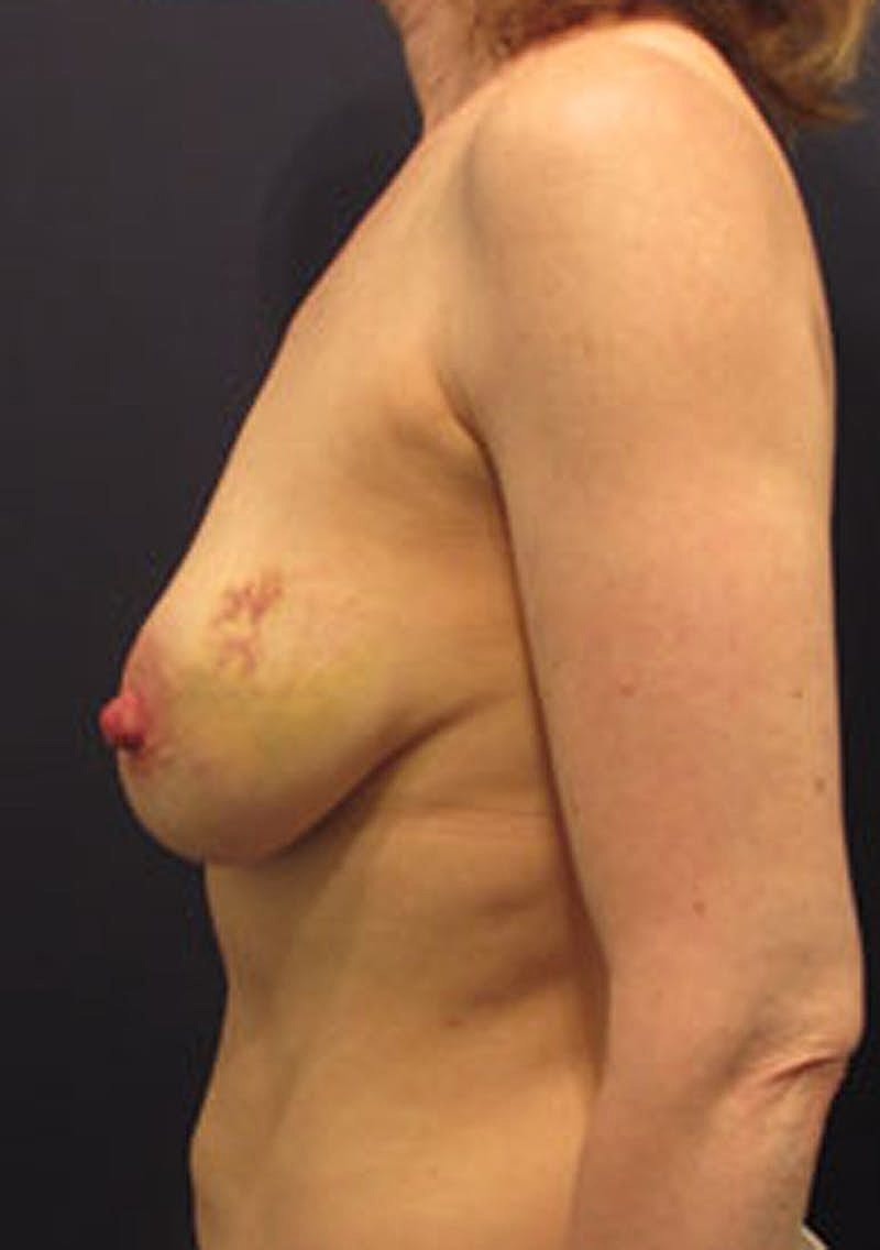 Breast Reconstruction Before & After