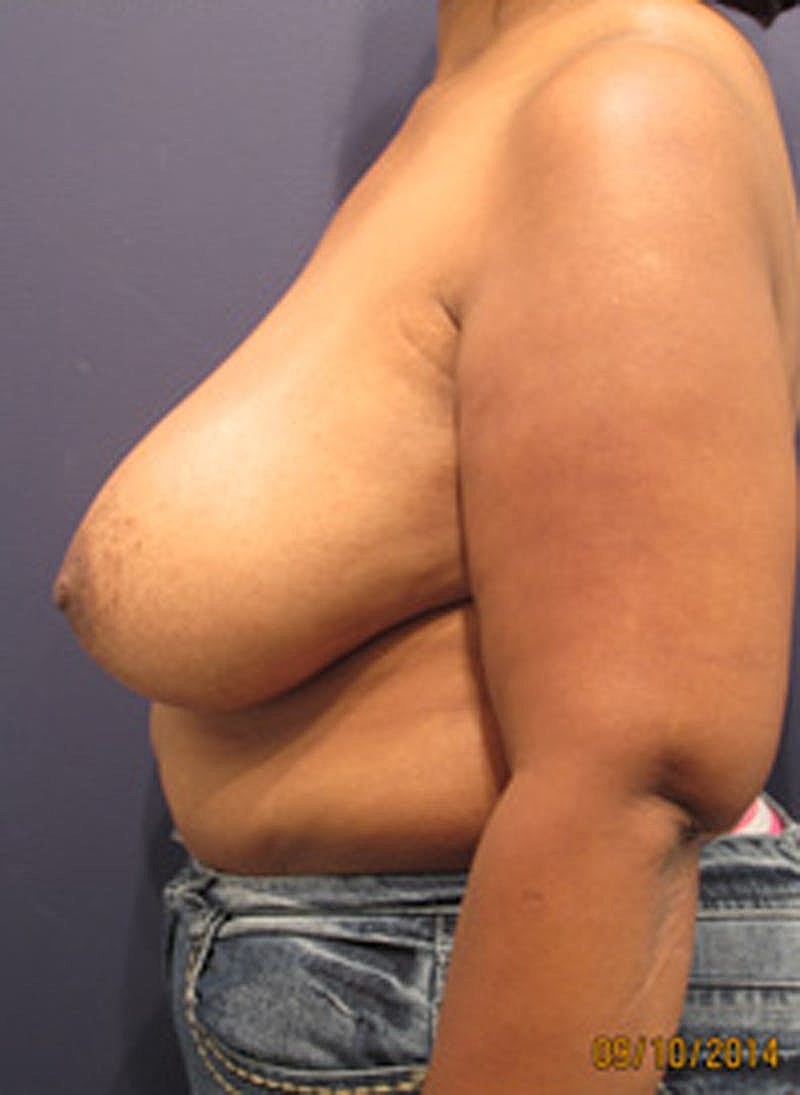 Breast Reconstruction Before & After