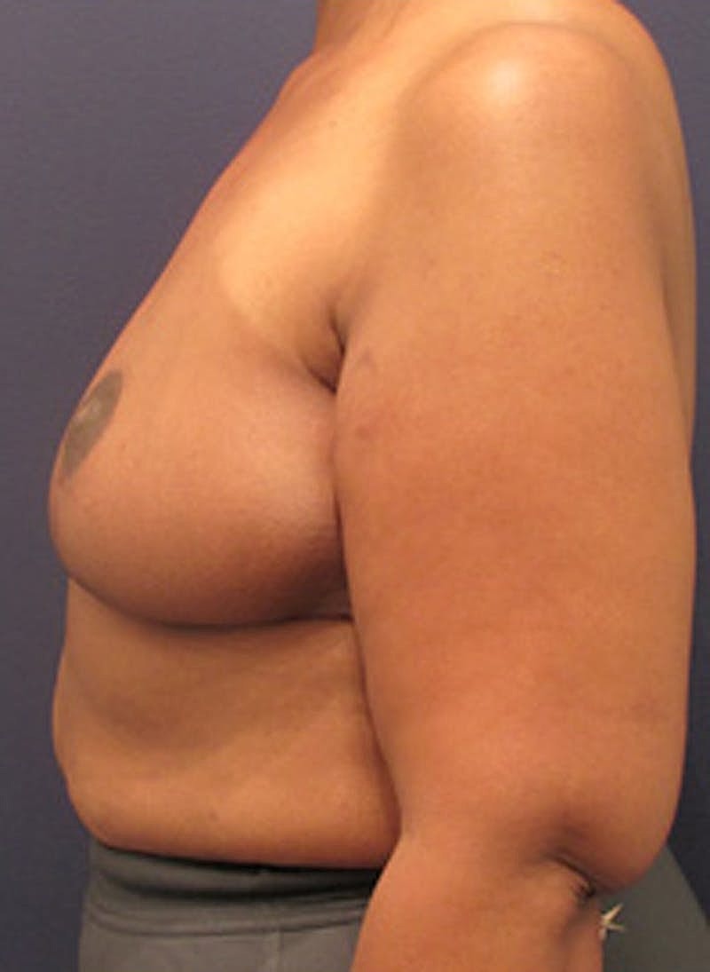 Breast Reconstruction Before & After