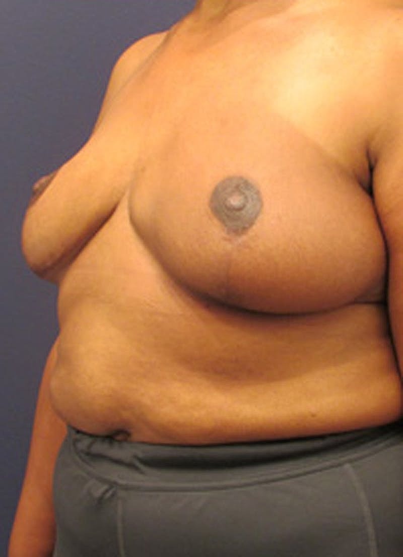 Breast Reconstruction Before & After
