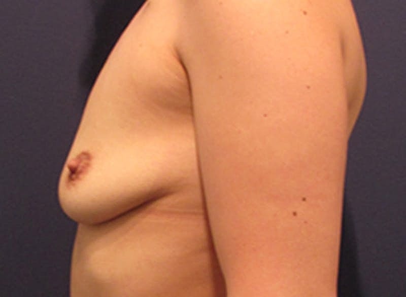 Breast Reconstruction Before & After