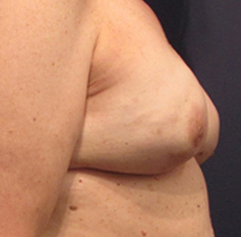 Breast Reconstruction Before & After