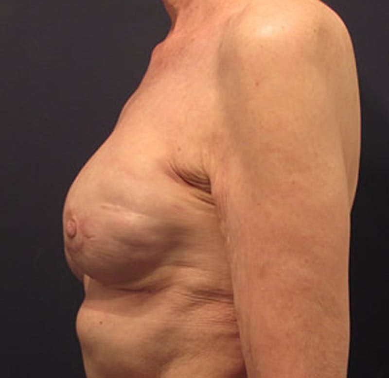 Breast Reconstruction Before & After
