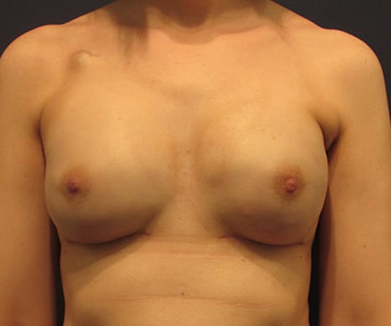 Breast Reconstruction Before & After