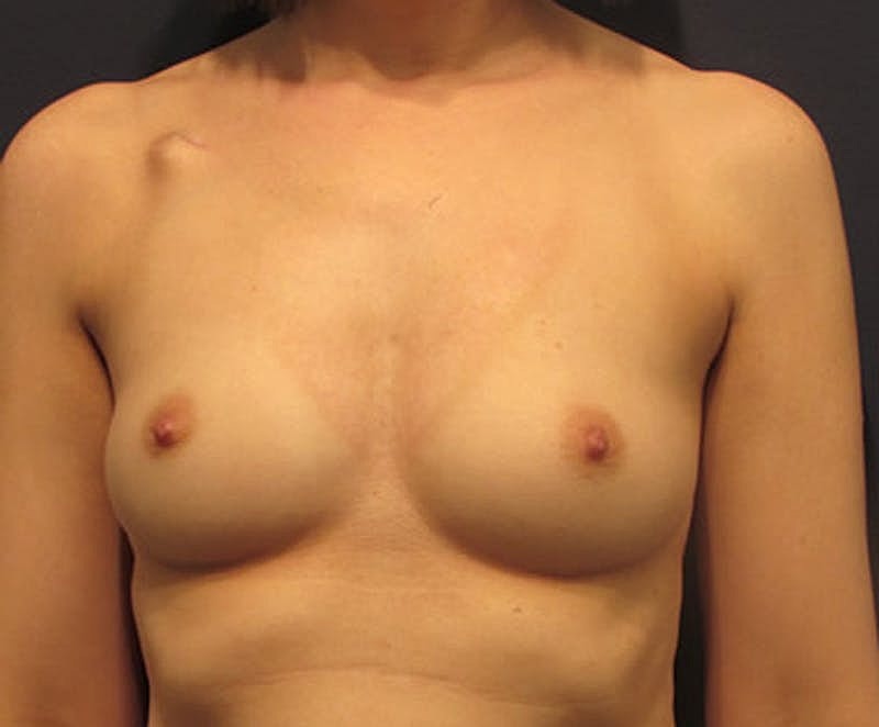 Breast Reconstruction Before & After