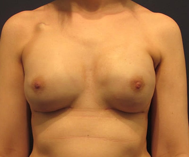 Breast Reconstruction Before & After