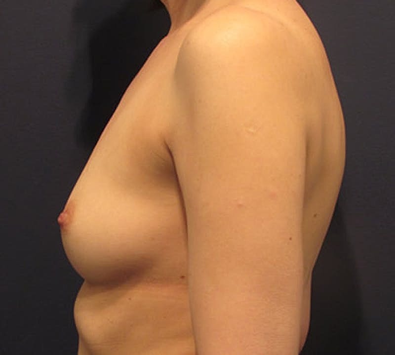 Breast Reconstruction Before & After