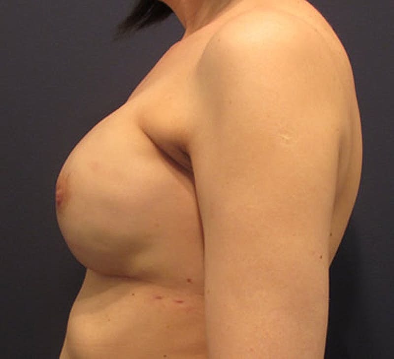 Breast Reconstruction Before & After